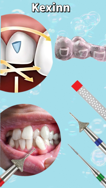 Innovative Integration Of Orthodontic Buttons And IPR Technology Elevates Clear Aligner Therapy Outcomes