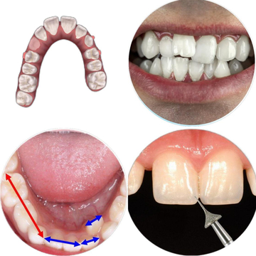 New Breakthrough In Orthodontics: Minimal Invasion To Balance Teeth Differences And Reshape Perfect Occlusion